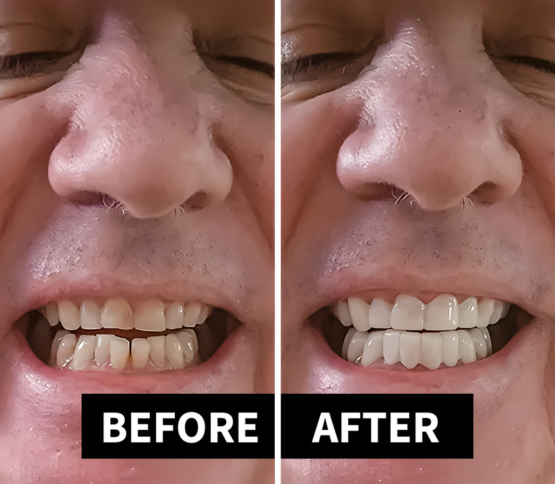 Shiny Smile Veneers 6