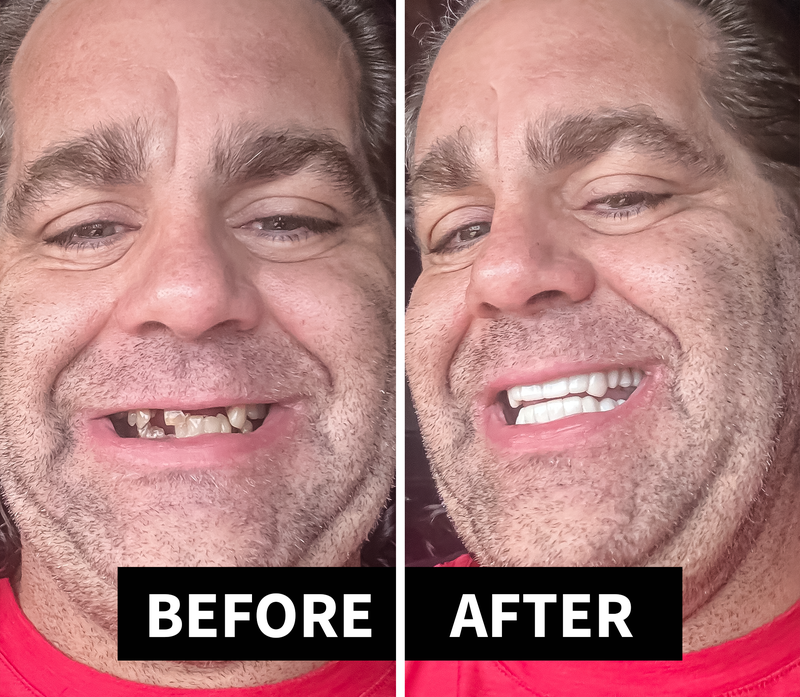 Shiny Smile Veneers 7