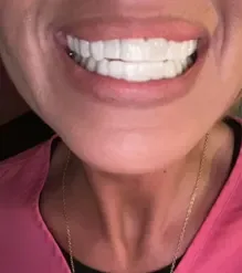 Shiny Smile Veneers 10
